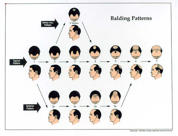 figure showing balding patterns